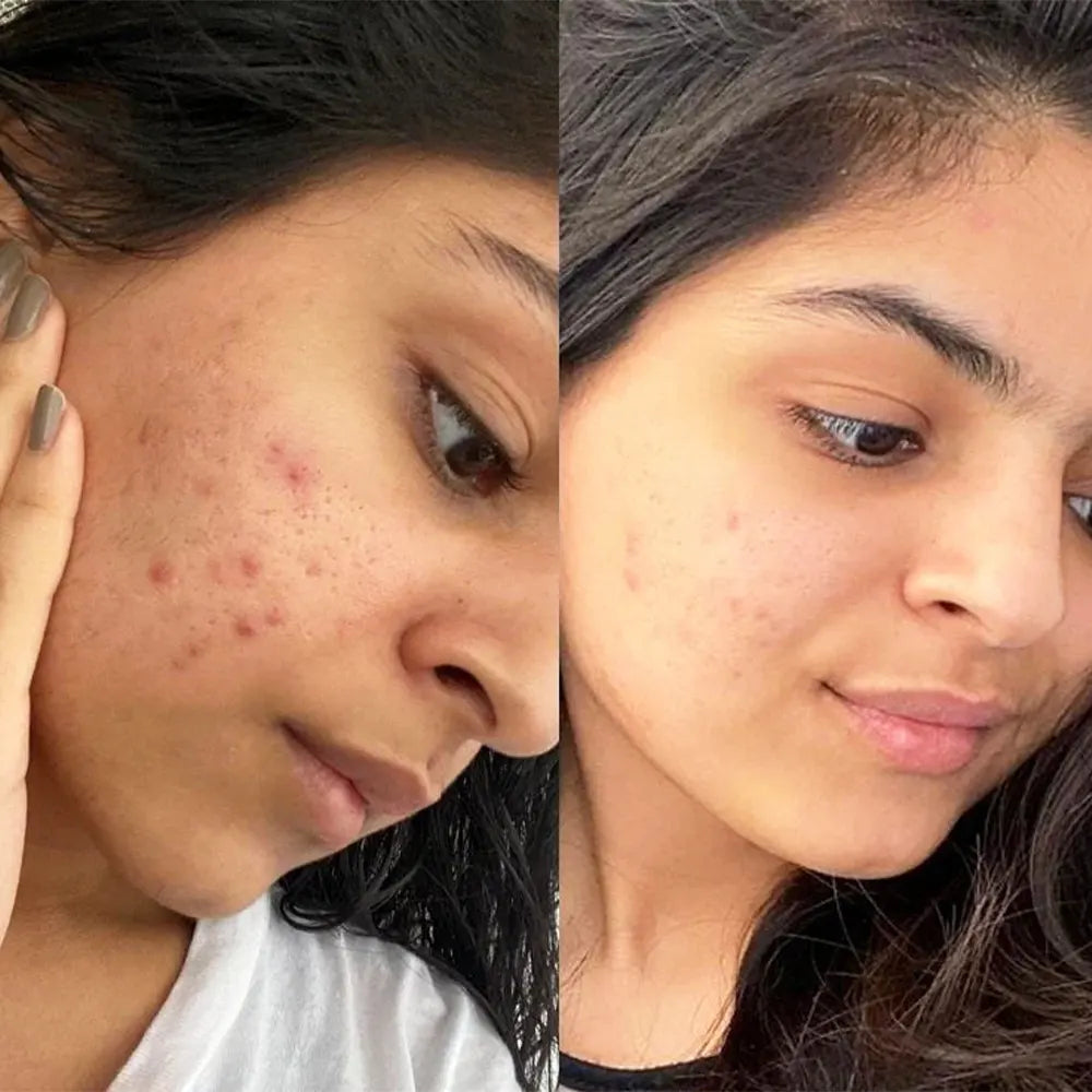 Moroccan Beauty Routine Acne Treatment